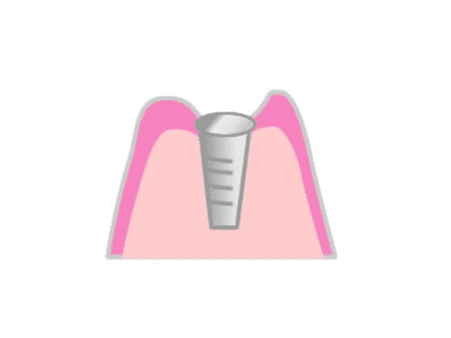 人工歯根と顎の骨が結合するまで待機
